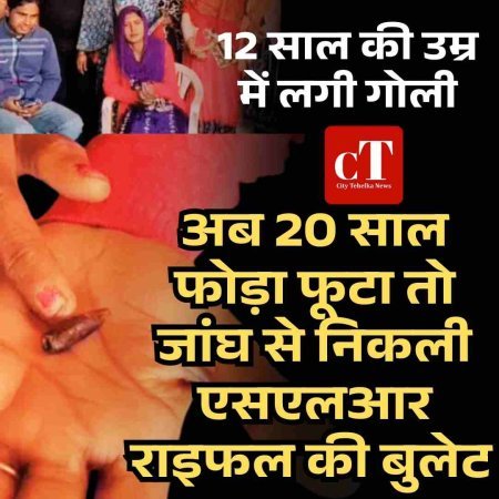12 साल की उम्र में लगी गोली अब 20 साल फोड़ा फूटा तो जांघ से निकली एसएलआर राइफल की बुलेट