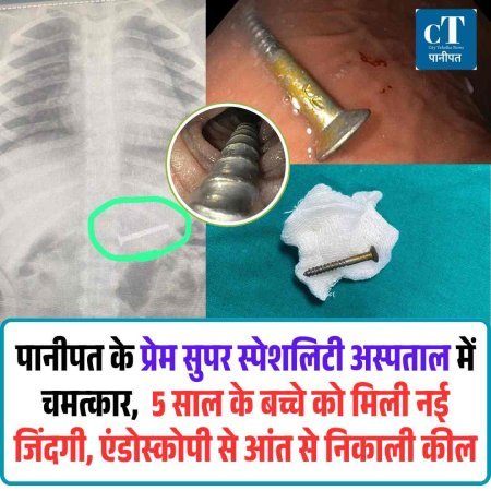 पानीपत के प्रेम सुपर स्पेशलिटी अस्पताल में चमत्कार, एंडोस्कोपी से 5 साल के बच्चे की आंत से निकाली कील